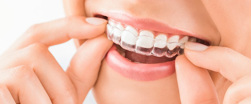 Clear Aligners Weston FL, How Clear Aligners Work