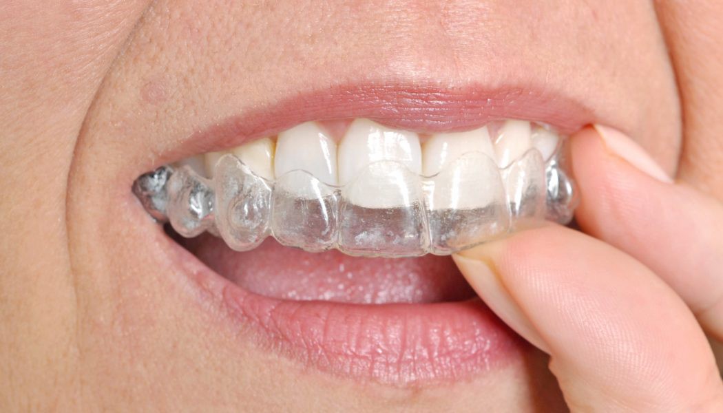 Clear Aligners Weston FL, How Clear Aligners Work